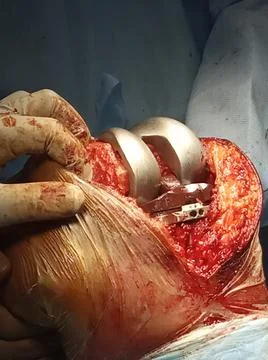 Knee bone surgery Stock Photos