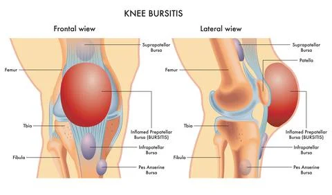 Knee bursitis Stock Illustration