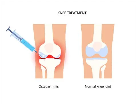 Knee Injection concept Stock Illustration