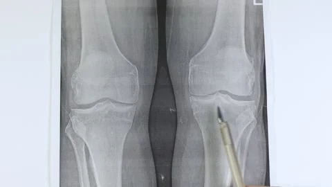 Knee joint arthritis Stock Footage 330889444