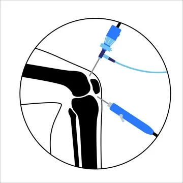 Knee joint arthroscopy Stock Illustration