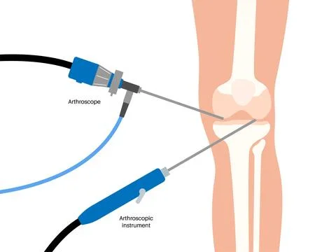 Knee joint arthroscopy Stock Illustration