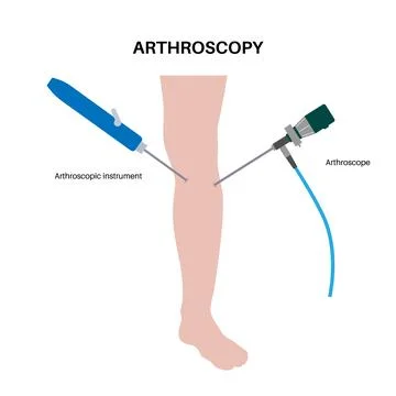 Knee joint arthroscopy Stock Illustration