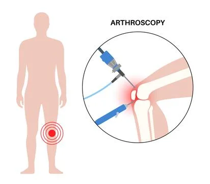 Knee joint arthroscopy Stock Illustration
