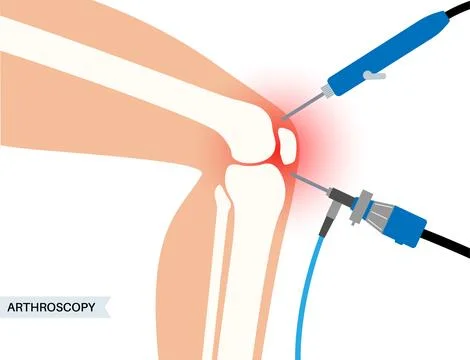 Knee joint arthroscopy Stock Illustration