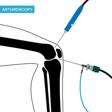 Knee joint arthroscopy Stock Illustration
