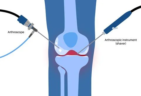 Knee joint arthroscopy Stock Illustration
