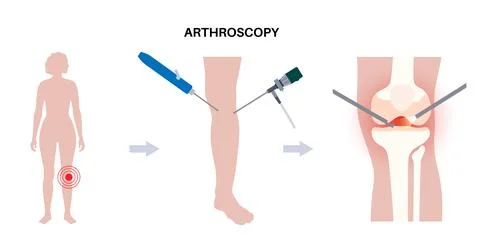 Knee joint arthroscopy Stock Illustration
