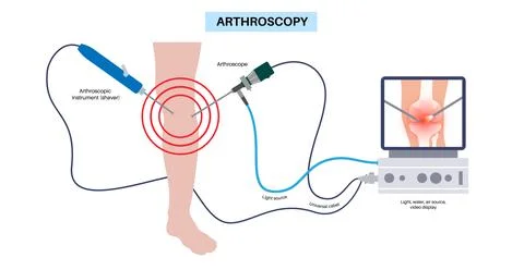 Knee joint arthroscopy Stock Illustration