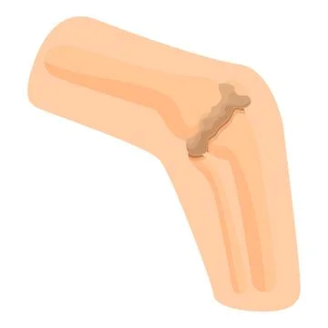 Knee joint with damaged bone and cartilage representing arthritis, osteoporos 스톡 일러스트