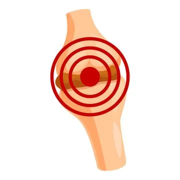 Knee joint experiencing inflammation and pain, highlighting orthopedic heal.. Stock Illustration