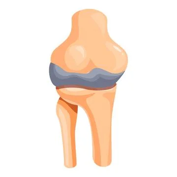 Knee joint implant replacing damaged cartilage and bones Stock Illustration