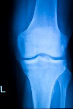 Knee joint meniscus x-ray test scan Foto stock