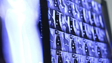 Knee joint MRI shots. Scans of the traumatized limb getting ready for operation. Stock Footage 301245632