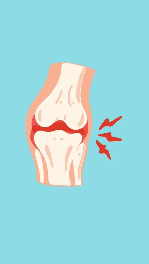 Knee joint pain animation Stock Footage 340956165