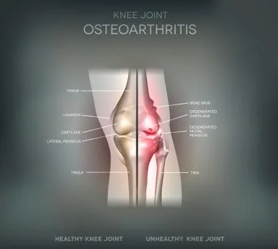 Knee joint problems Illustrazione stock
