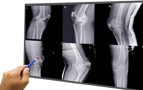 Knee joint x-ray collection fracture different views. Stock Photos