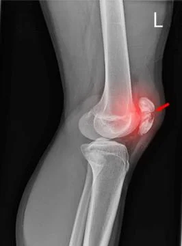Knee joint x-ray Stock Photos