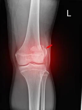 Knee joint x-ray Stock Photos