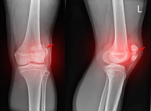 Knee joint x-ray Stock Photos
