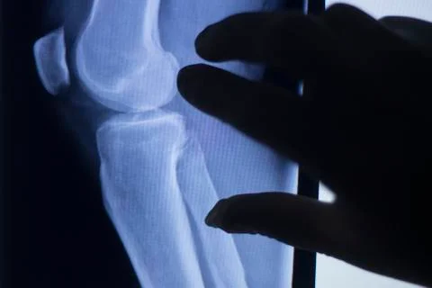 Knee joint xray test scan Stock Photos
