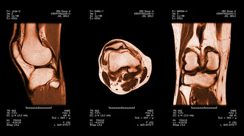 Knee MRI scan. Loopable. Amber. Stock Footage 32194025