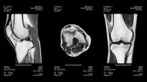 Knee Mri Scan. Loopable. Black and white. Stock Footage 62390246