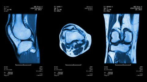 Knee MRI scan. Loopable. Blue. Stock Footage