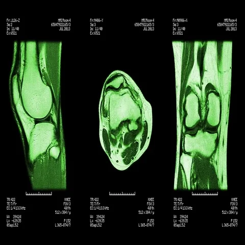 Knee MRI scan. Loopable. Stock Footage 69600511