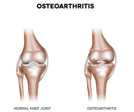 Knee Osteoarthritis Stock Illustration