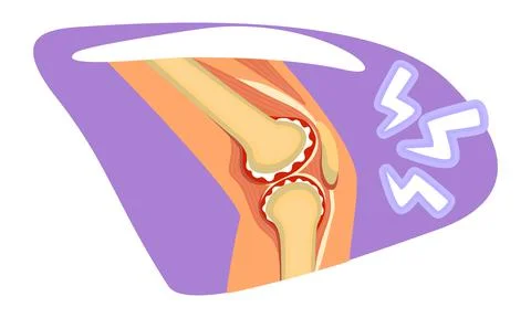 Knee pain 2D vector isolated illustration Illustrazione stock