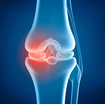 Knee problem, x-ray view Stock Illustration