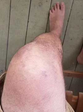 Knee Replacement Hematoma Фото
