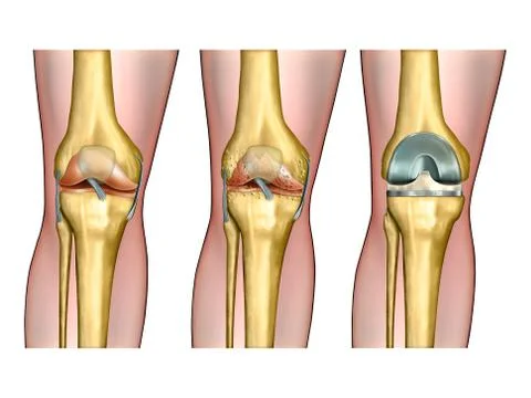 Knee replacement Stock Illustration