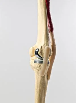 Knee replacement Stock Photos