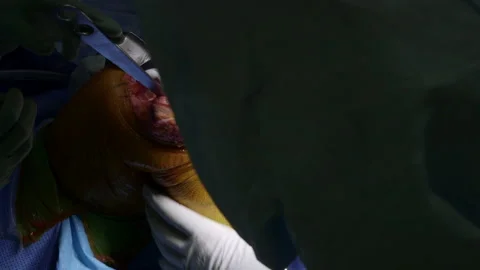 Knee replacement surgery Stock Footage 239365585