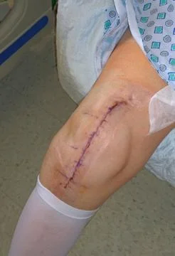 Knee replacement surgery scar Stock Photos