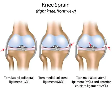 Knee sprain Illustrazione stock