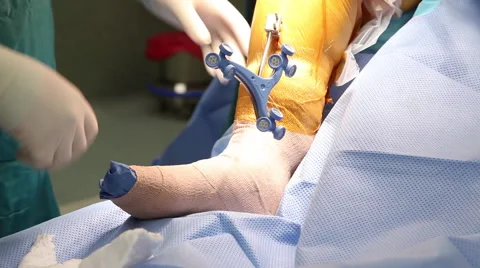 Knee Surgery 2 Vídeo Stock 55531542