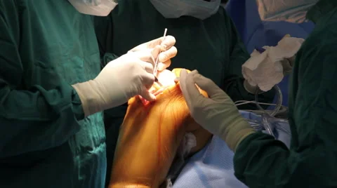 Knee Surgery 3 Vídeo Stock 55531453