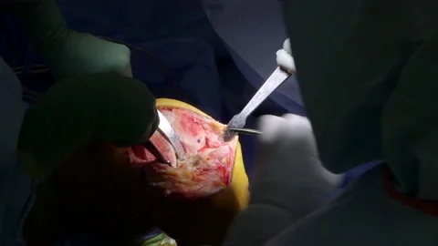 Knee surgery Stock Footage 239365591