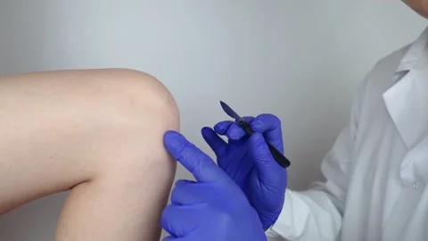 Knee surgery. Orthopedic surgeon shows patient where the incision will be made t Stock Footage 245802353