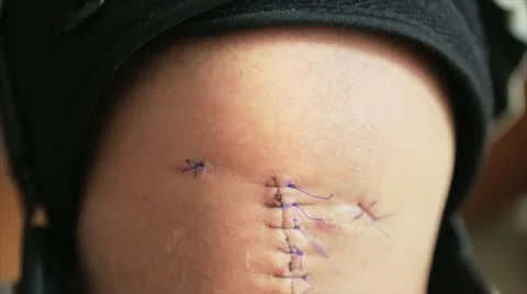 Knee Surgery Scarr Stock Footage 12140699