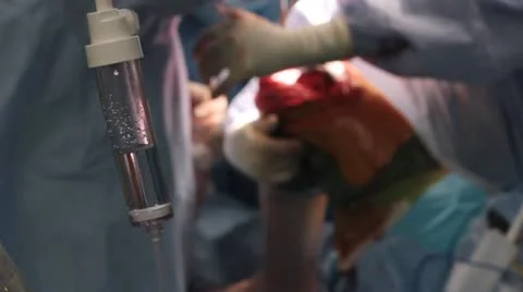 Knee surgical procedure (5 of 15) Stock Footage