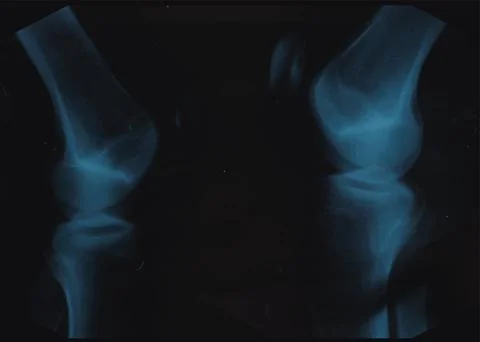 Knee X-Ray, realistic scan, vector illustration Stock Illustration
