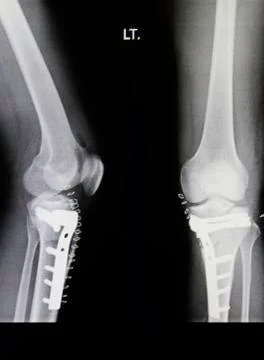 Knee x-rays image showing plate and screw fixation Stock Photos