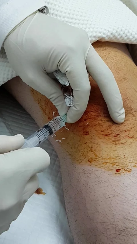 KneeInjection2 Stock Footage 330817714