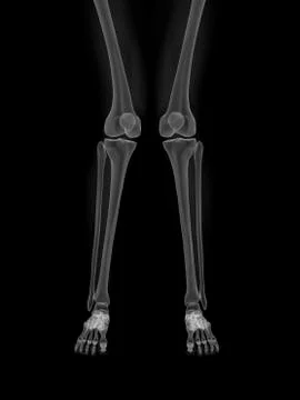 Knock knee, artwork Illustrazione stock
