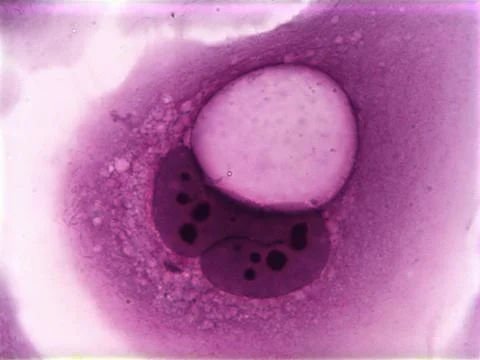 Koilocytes, squamous epithelial cells, altered by human papillomavirus Stock Photos