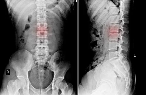 L-S Spine(Lumbo-SACRAL) AP.LATERAL Stock Photos